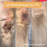 Lymfedrainage bij CPL - Tyra